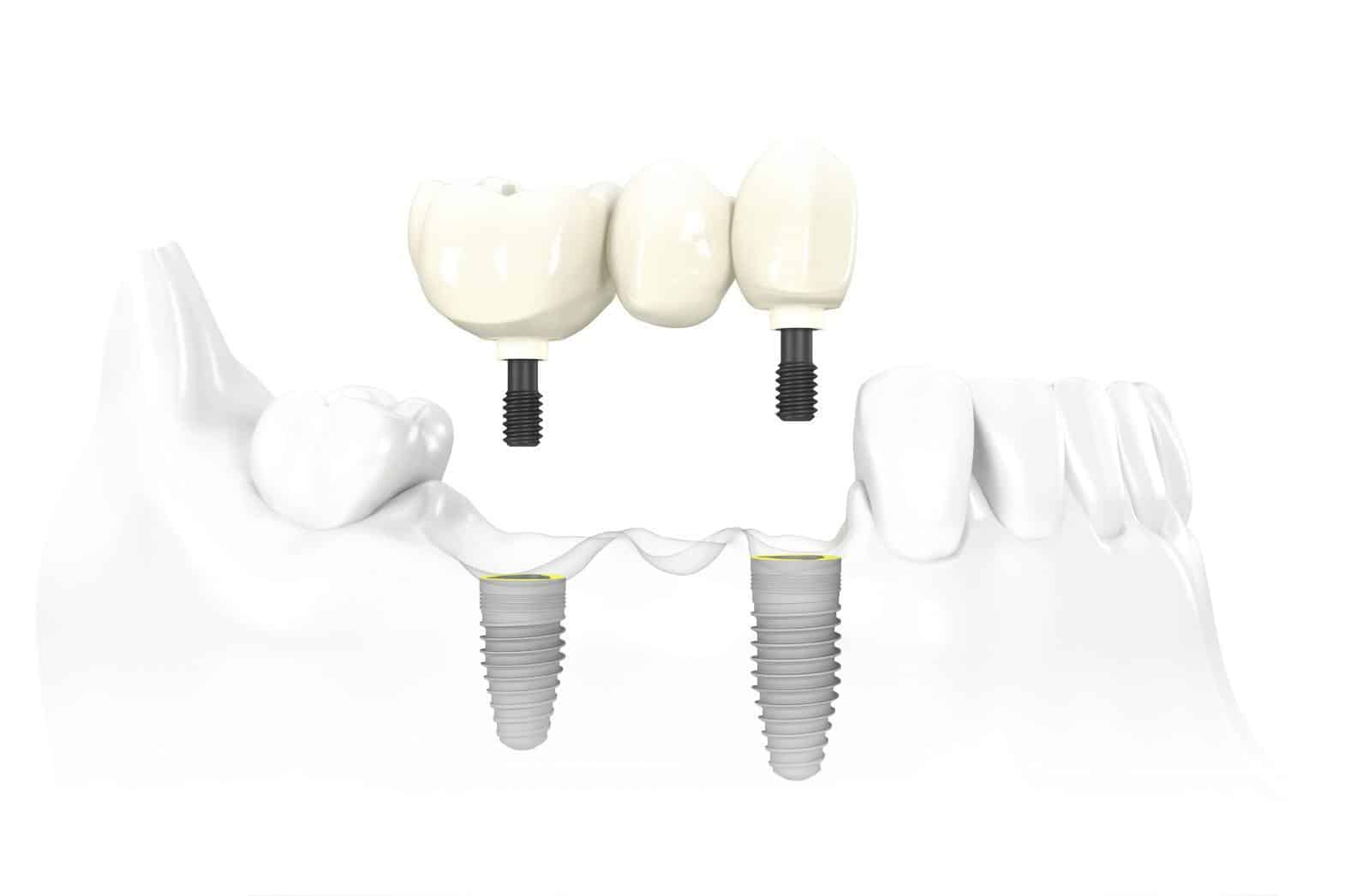 Implant Bridge
