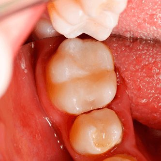 White fillings - After